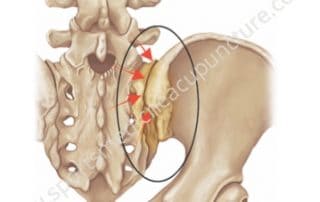 Assessment & Treatment of Sacroiliac Joint Pain and Dysfunction | SportsMedicineAcupuncture.com