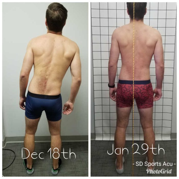 Left Antalgia Case Study: Correcting Severe Antalgic Posture & Gait