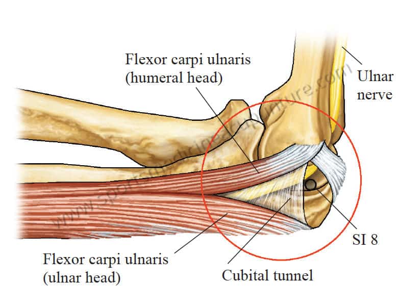 cubital tunnel syndrome)