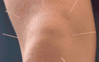 Successful Needle Technique for Patellar Pain Syndromes | SPORTSMEDICINEACUPUNCTURE.COM