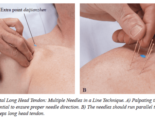 Bicipital Tenosynovitis: Ortho Exam, LU 6 and Multiple Needles in a Line Needle Technique
