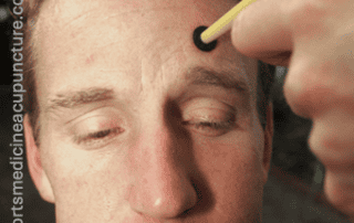 GB 14 and It’s Many Clinical Applications | SPORTSMEDICINEACUPUNCTURE.COM